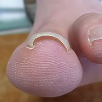 巻き爪　補正前 